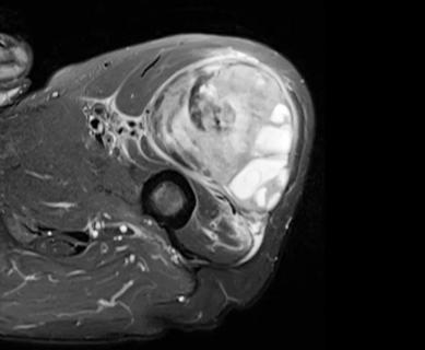 MRI of soft tissue sarcoma