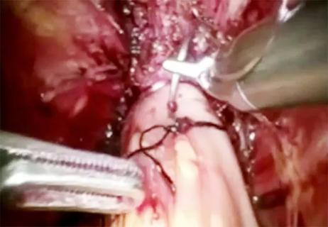 650&#215;450 Robotic Cystectomy