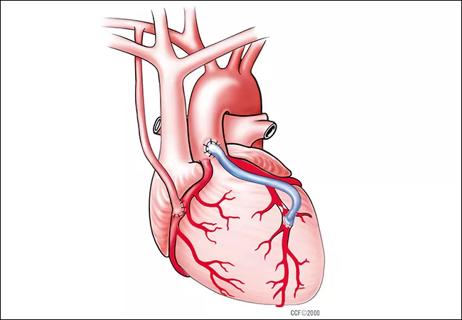 Diabetes Doesn’t Influence Long-Term Graft Patency After Heart Bypass Surgery