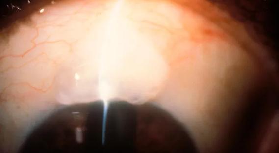 Traditional vs minimally invasive glaucoma
