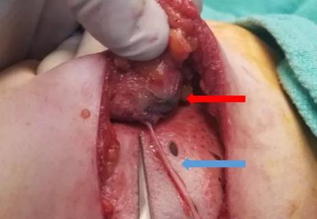 Coaptation of the nerve allograft and and nipple-areolar complex