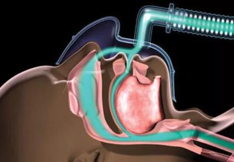 positive airway pressure therapy