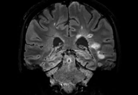 brain MRI showing central vein sign in a patient with multiple sclerosis