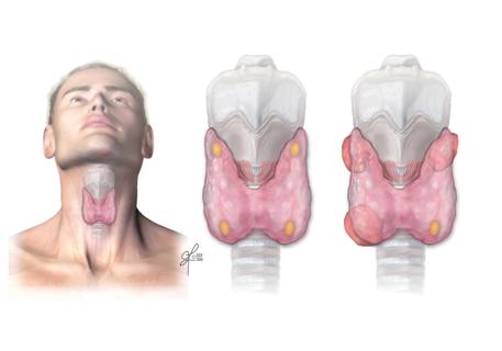 Parathyroid vs. adenoma