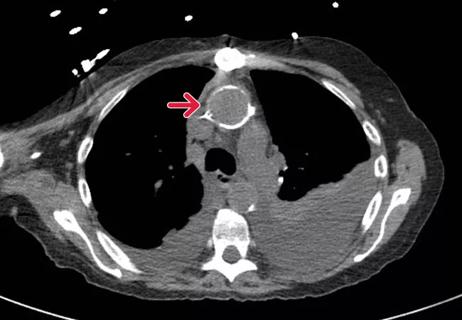 A noncontrast CT of the ascending aorta