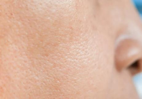 A close up of pores on someone's cheek skin