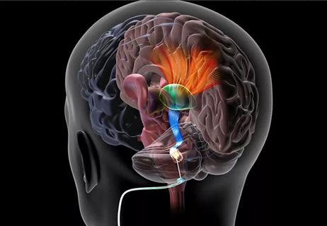 illustration showing target for deep brain stimulation of the dentate nucleus