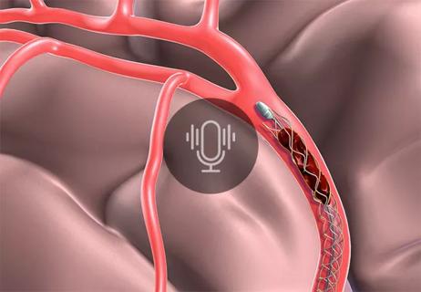 22-NEU-2715766-mechanical-thrombectomy-for-stroke-650&#215;450-podcast