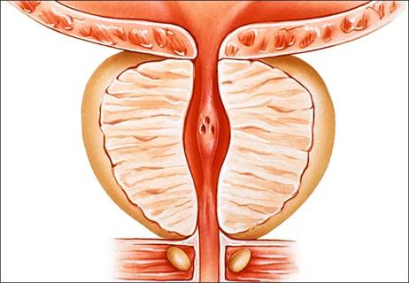 650&#215;450-enlarged-prostate