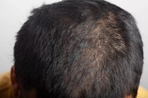 Closeup of a head with scalp psoriasis