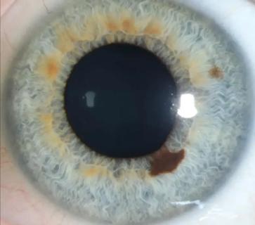 Eye with a lesion on the iris