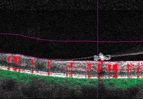 glp-1 macular degeneration GLP-1 Agonists May Lower Risk of Macular Degeneration