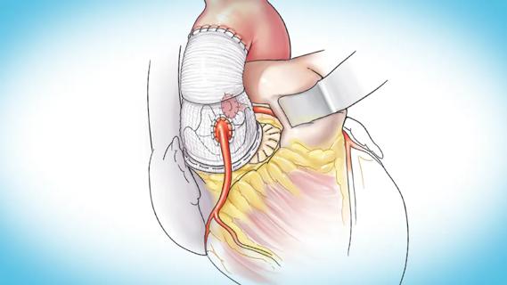illustration of human heart with a graft repair