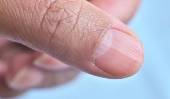 Close up of a person’s fingernail that shows vertical ridges along its surface