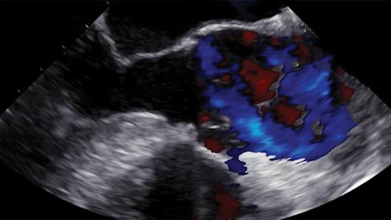 transesophageal echocardiogram showing type A aortic dissection