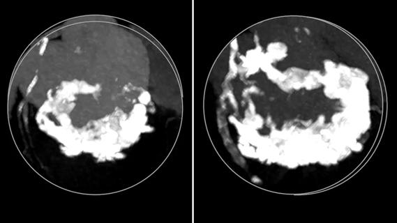 two CT scans showing calcification of the mitral valve