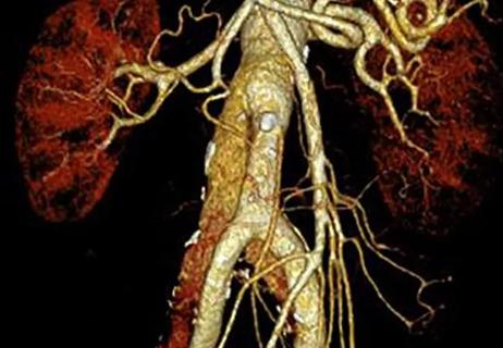 abdominal aortic aneurysm