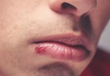 Young man with cold sore on lip