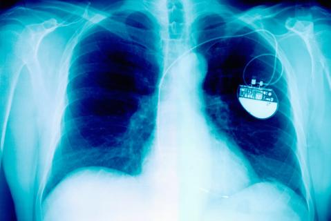 X-Ray Showing Pacemaker