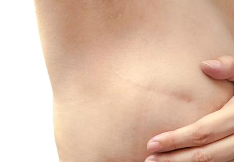 A closeup of a person with their arm raised showing a scar near their breast