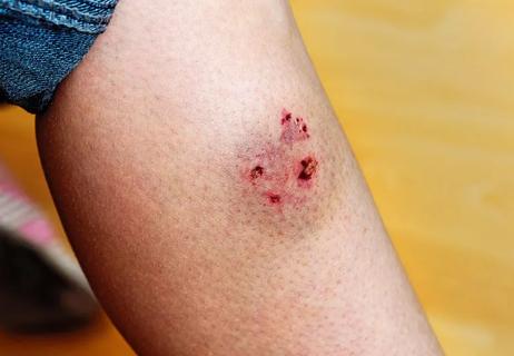 leg with dog bite wound