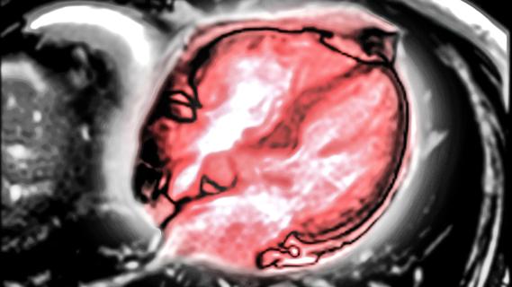 Image from a cardiac MRI.