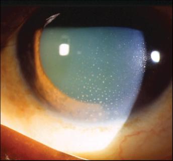 Eye with uveitis