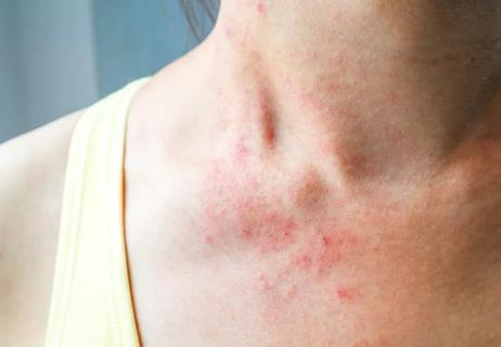 skin rash on neck
