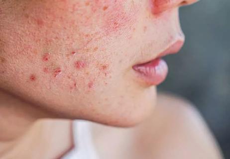 woman with hormonal acne along cheek and jaw
