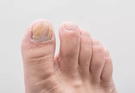 Closeup of a foot with yellowed fungus on big toe