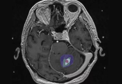 19-NEU-6043-brain-metastases-650&#215;450