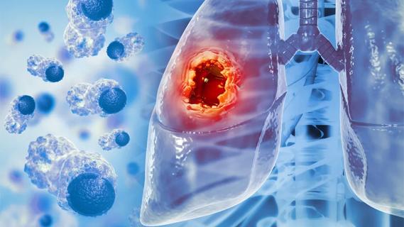 Lung cancer illustration