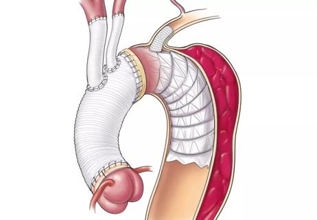 Aortic Dissection: Multistage Repair Featuring a Branched Frozen Elephant Trunk Technique