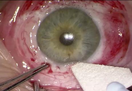 16-eye-2702-hc-surgery-cqd-feat