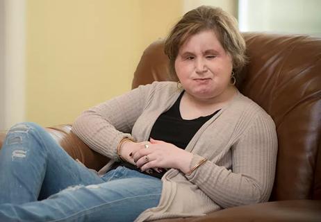 Katie Stubblefield After First Total Face Transplant