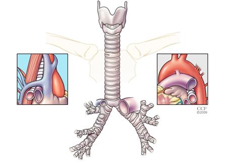 tracheobronchomalacia