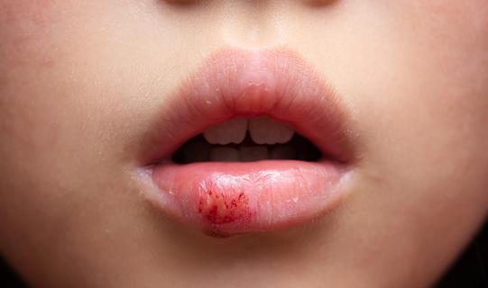 Child's with busted lip