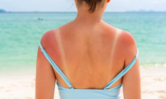 A person at the beach with sunburnt shoulders and pale lines where the bathing suit straps were