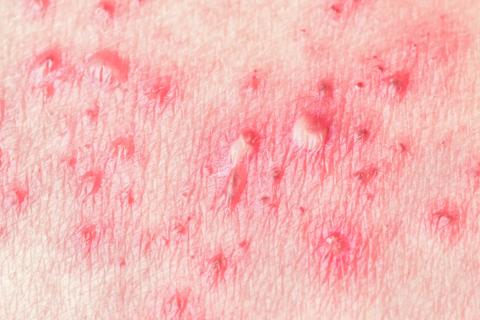 How You Can Avoid Shingles If You Have Cancer