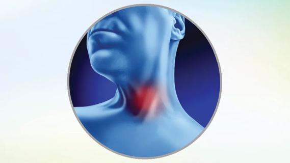 Throat cancer
