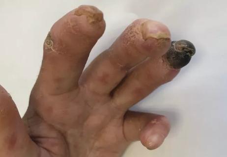 Raynaud's disease leading to digital ulcer in a patient with scleroderma
