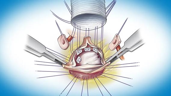 illustration of a stent graft being surgically placed on a heart valve