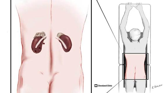 Medical diagram of adrenal glands seen through the back of a patient