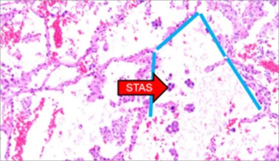 histology image of lung tissue showing spread through air spaces (STAS)