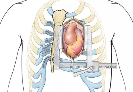 21-HVI-2215858-pectus-excavatum-repair-650&#215;450