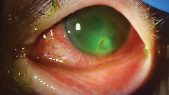 Closeup of eye with peripheral ulcerative keratitis.