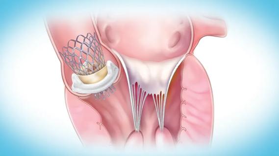 illustration showing a heart valve within another heart valve in the heart
