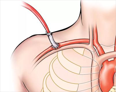 650&#215;450-axillary-cannulation