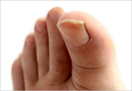 To Diagnose Critical Limb Ischemia, Look to the Toe as Well as the Ankle