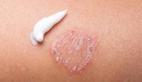 Ringworm on the skin, with a smear of antifungal cream by it, ready to be rubbed in